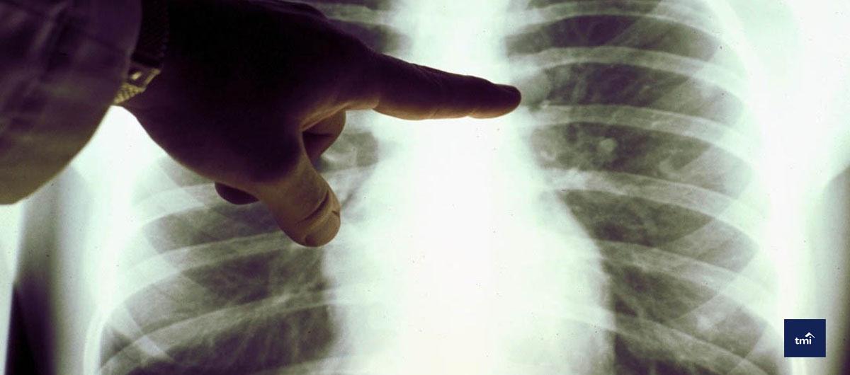 Important Facts About Lung Cancer