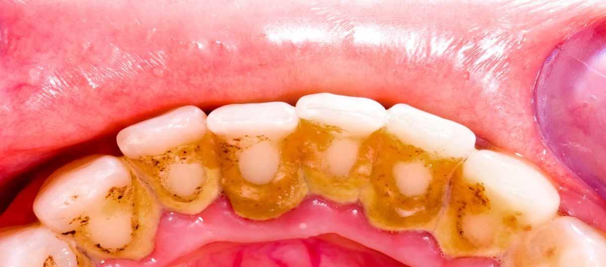 TMAZ remuve dental plaque