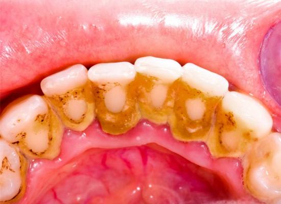 TMAZ remuve dental plaque
